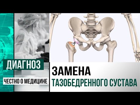 Эндопротезирование тазобедренного сустава: как проводят операцию в Казахстане | Диагноз