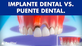 Puente dental fijo sobre diente natural - Comparativa con implantes ©