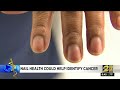 Nail health could help identify cancer