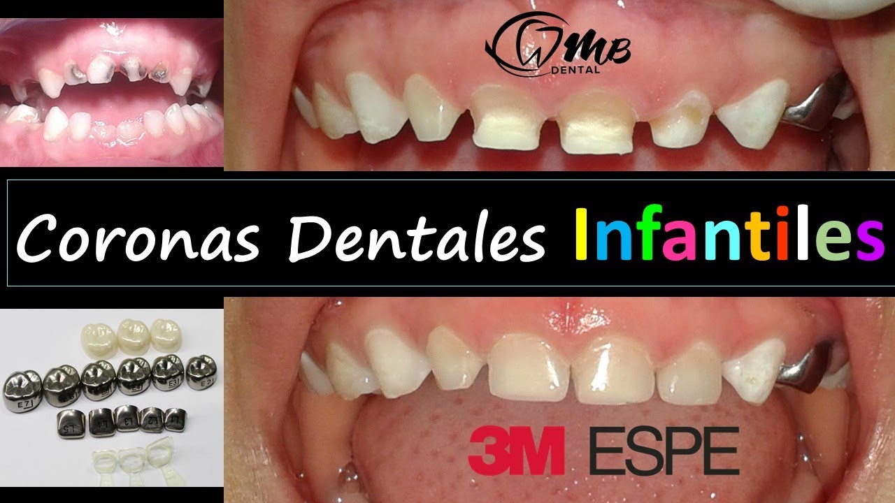 Watch Coronas Dentales INFANTILES. Odontopediatría. Now Coronas Dentales INFANTILES. Odontopediatría.