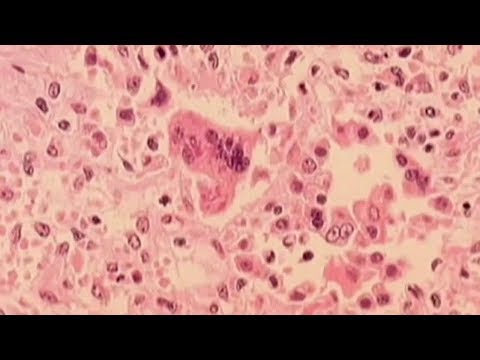 NJ Lakewood Measles Outbreak