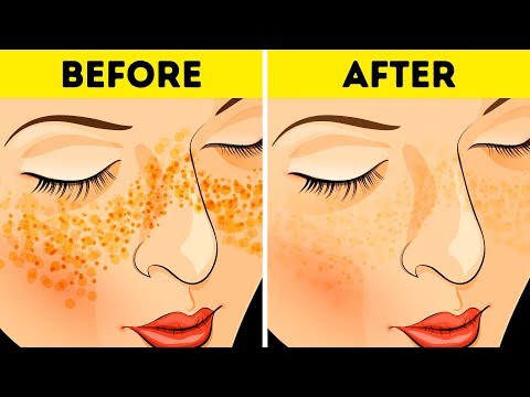 How to Get Rid of Acne Scars and Spots In Just 3 Days