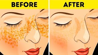 How to Get Rid of Acne Scars and Spots In Just 3 Days