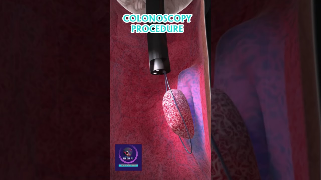How to Performed Colonoscopy | Endoscopy Procedure |