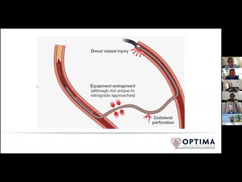 CTO & COMPLEX PCI - Session 3 -"Retrograde Approach-CTO" | Dr.Arun Kalyanasundaram | Promed Hospital