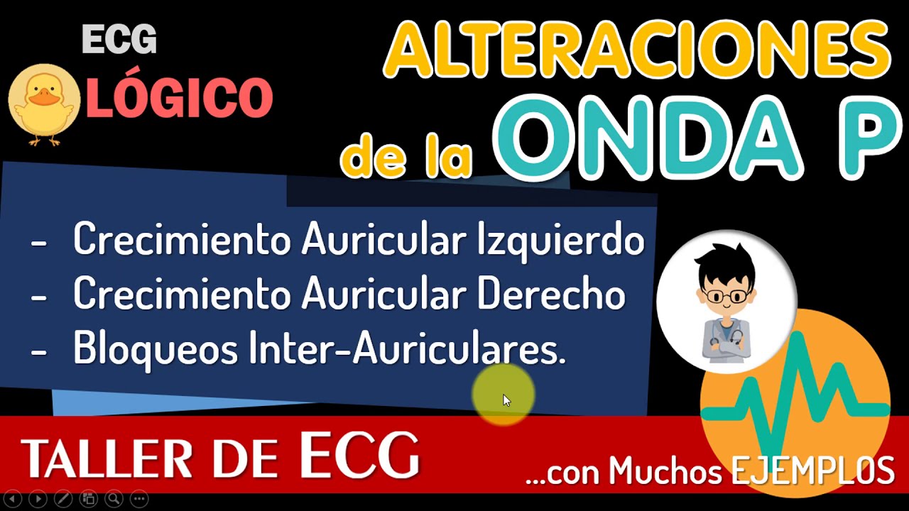 CRECIMIENTO Auricular IZQUIERDO y DERECHO. Criterios Electrocardiograma, Casos Clínicos.