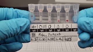 Blood Banking: Gel Antibody Screen
