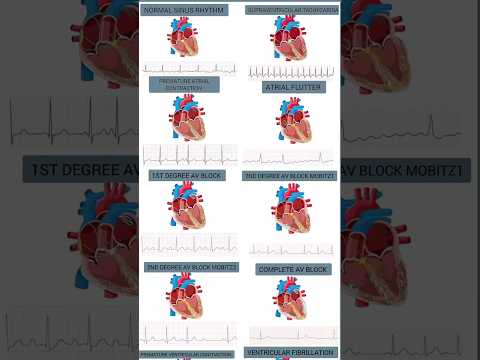 Most common Arrhythmias (heart motion + rhythm strip) #cardiology #medicalstudent #usmle #medstudent