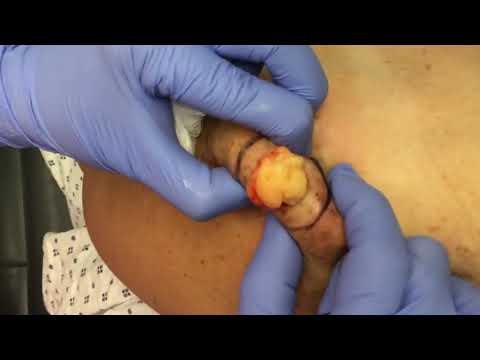 Lipoma férgek - Enterobiasis (pinworms) - Egészség