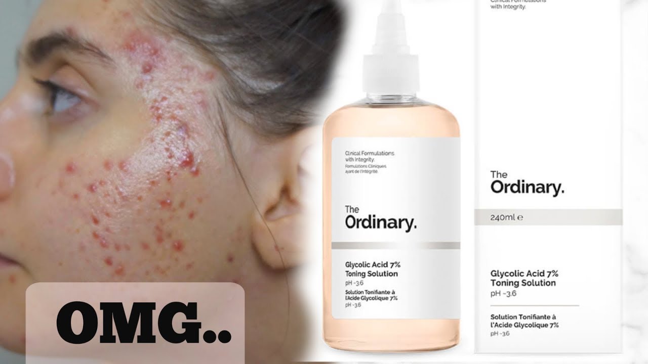 I Tested The Ordinary Glycolic Acid Toner Every Day For A Week || These are my thoughts..