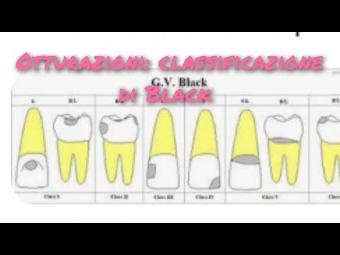 Fillings: Black's classification