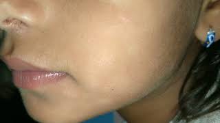fungal infection of the face note white patches