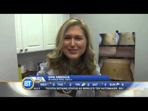 Stretch Mark Removal in Toronto on BT with Dr. Mulholland | SpaMedicaTV
Video Thumbnail
