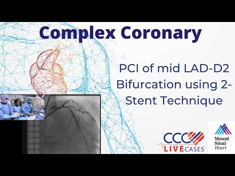 PCI of mid LAD-D2 Bifurcation using 2-Stent Technique - October 16, 2018
