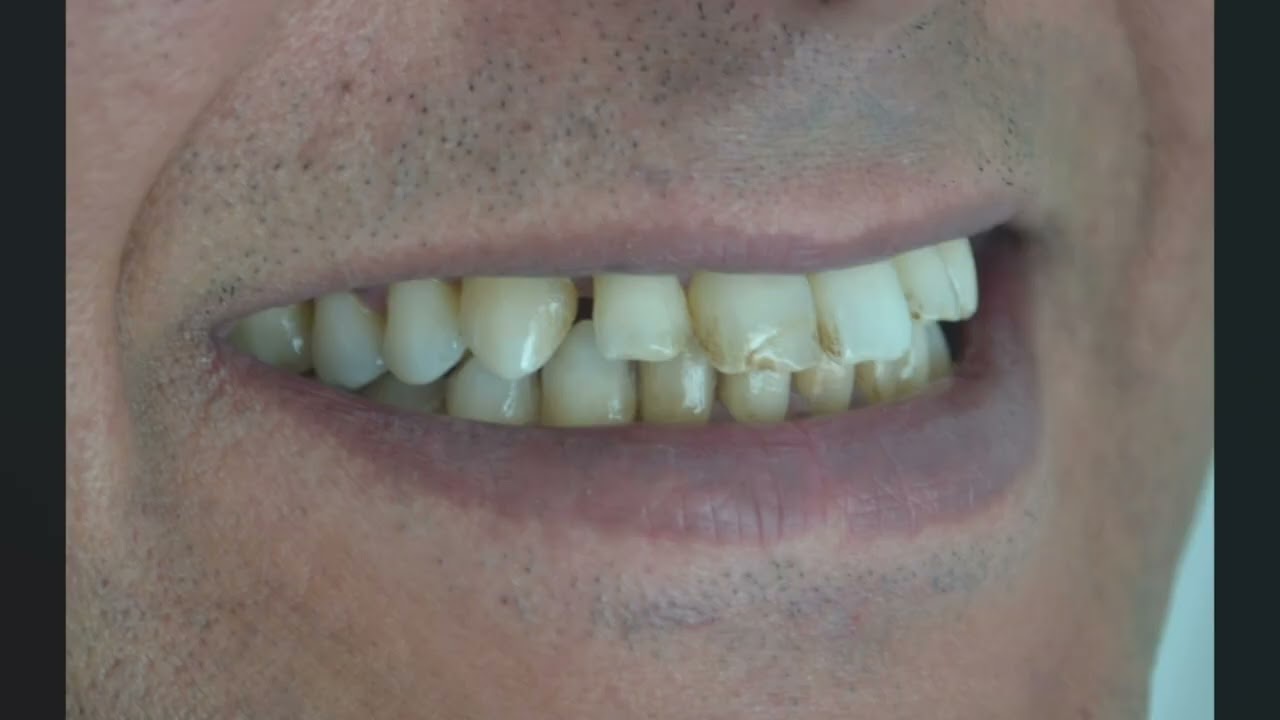 Angulations Due to Loss of Supporting Tissue