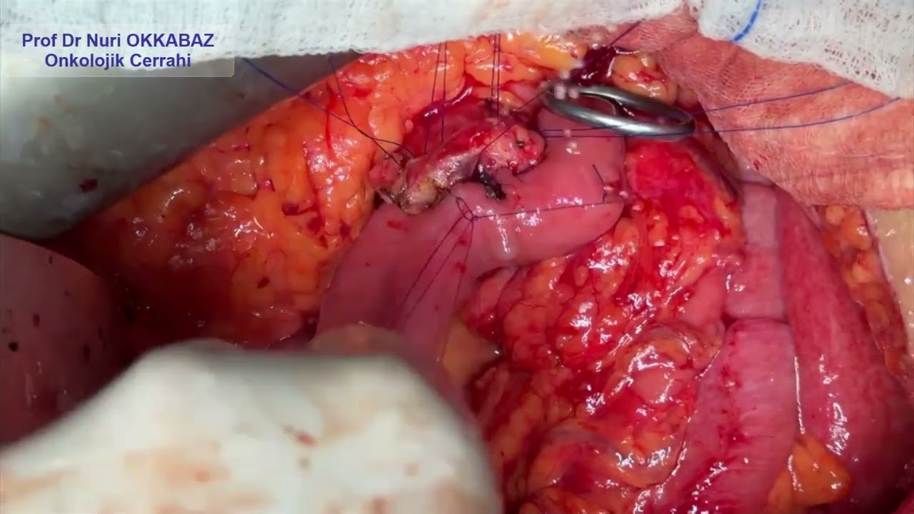 Pancreatic Cancer Surgery – Pancreatic Anastomosis Stage