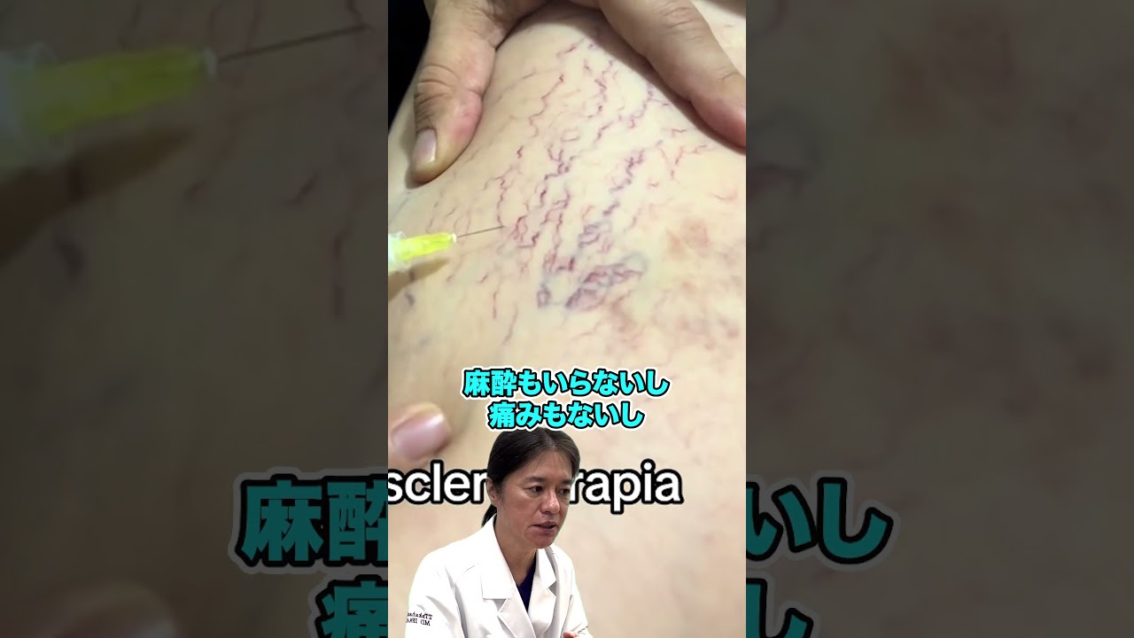 【クモ状血管腫】加齢によって浮き出て目立つ血管腫！より確実に消したい方は血管YAGレーザー治療を推奨！