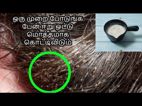 முடியில் ஒட்டி இருக்கிற ஈறு பேன்  ஒட்டு மொத்தமாக கொட்டிவிடும் | lice home remedy in tamil