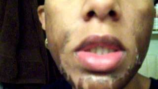 Jessner's Chemical Peel 30% with 20% Salicylic Acid on top- Morning 6- After Wash &amp; Oiling Process