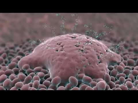 Što je cistična fibroza