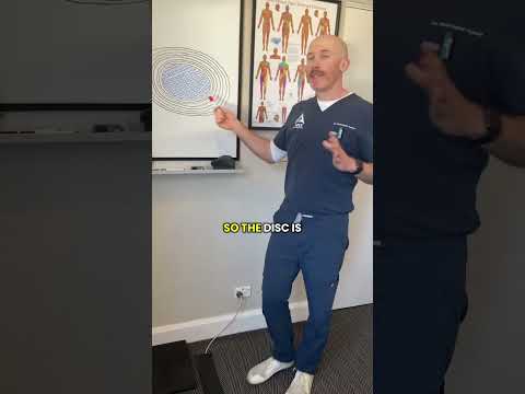 Chronic pain caused by ANNULAR TEAR