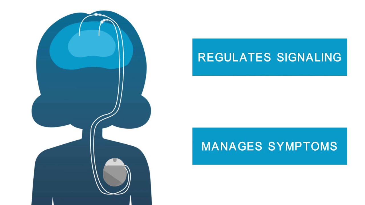Boston Scientific - Deep Brain Stimulation for Dystonia - Dystonia Sketch Animation - English