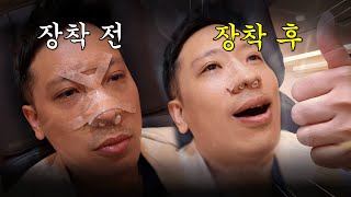 코수술 이제 할만한데? ❌솜황장애 아웃❌