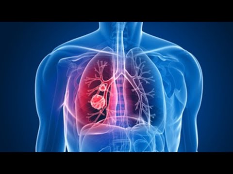 Lung Cancer, Emphysema & COPD in the 9/11 Community Webinar — hosted by Barasch & McGarry Video Thumbnail