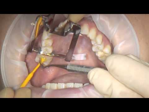 Bausch Approximal Contact Forceps | Medentrx