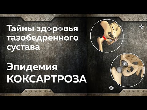 Артроз тазобедренного сустава. Коксартроз. Боль в бедре. Профилактика и лечение.