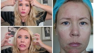 25 YEARS OF SKIN PICKING! (Dermatillomania)  | BEAUTY OVER 40