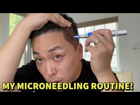 MY MICRONEEDLING ROUTINE TO TREAT HAIR LOSS!