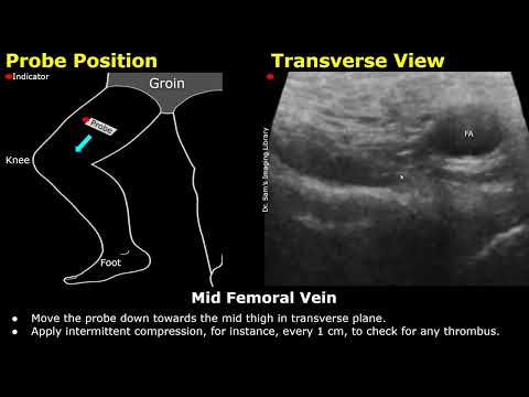 Femoral Vein Doppler Ultrasound Probe Positioning | Lower Limb Veins USG Scanning Technique