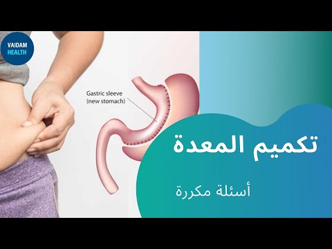 الأسئلة المتداولة حول تكميم المعدة