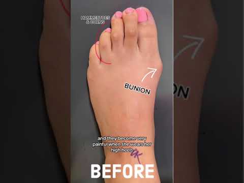 Don't Let Corns and Bunions Rule Your Life... See This Amazing Transformation!