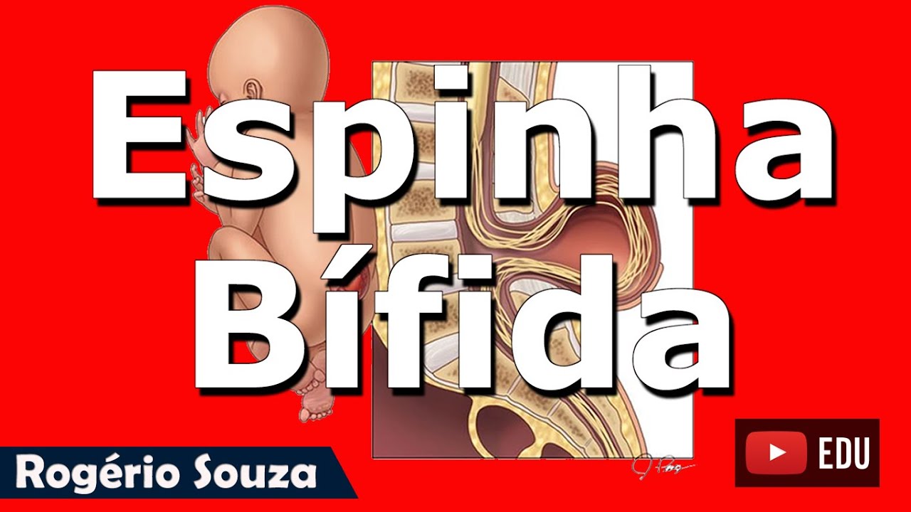 ESPINHA BÍFIDA (Vídeo Aula) - Rogério Souza (1/2)