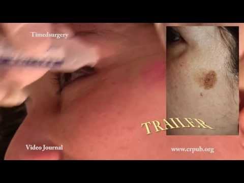 Il pigmentary nota su una faccia della ragione e il trattamento da rimedi di gente In profondità peeling di una faccia con decolorazione