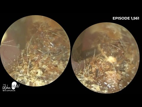 1,561 - Rock solid #earwax plugs removed using the Rai Angled Ear Hook & Rai Angled Ear Pick