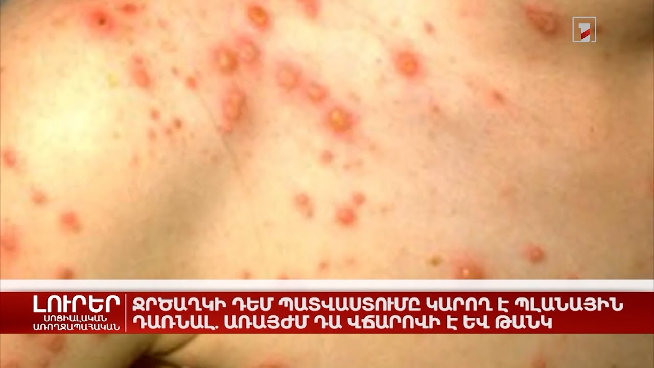 Ջրծաղիկի դեմ պատվաստումը կարող է պլանային դառնալ. առայժմ դա վճարովի է և թանկ