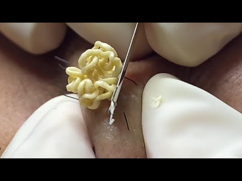 Intense Pore Cleaning Techniques | Cyst Acne & Blackhead Removal ASMR Experience
