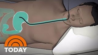 New ‘Accordion’ Procedure Could Help People Lose 40 Pounds Without Surgery | TODAY