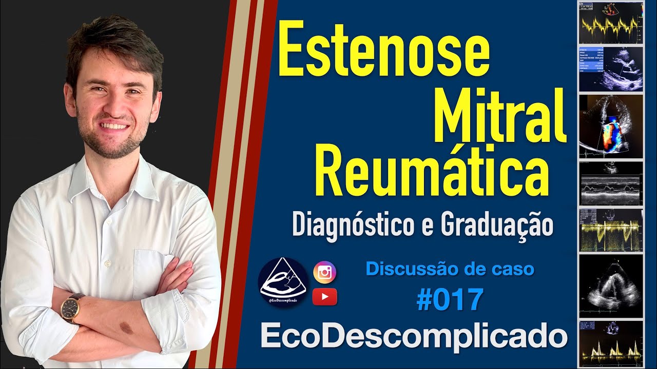 EcoDescomplicado - Discussão de caso AO VIVO #017 - Estenose Mitral Reumática - NOVA DIRETRIZ 2022