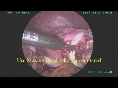 Amputacja szyjki macicy podczas laparoskopowej nadszyjkowej histerektomii.