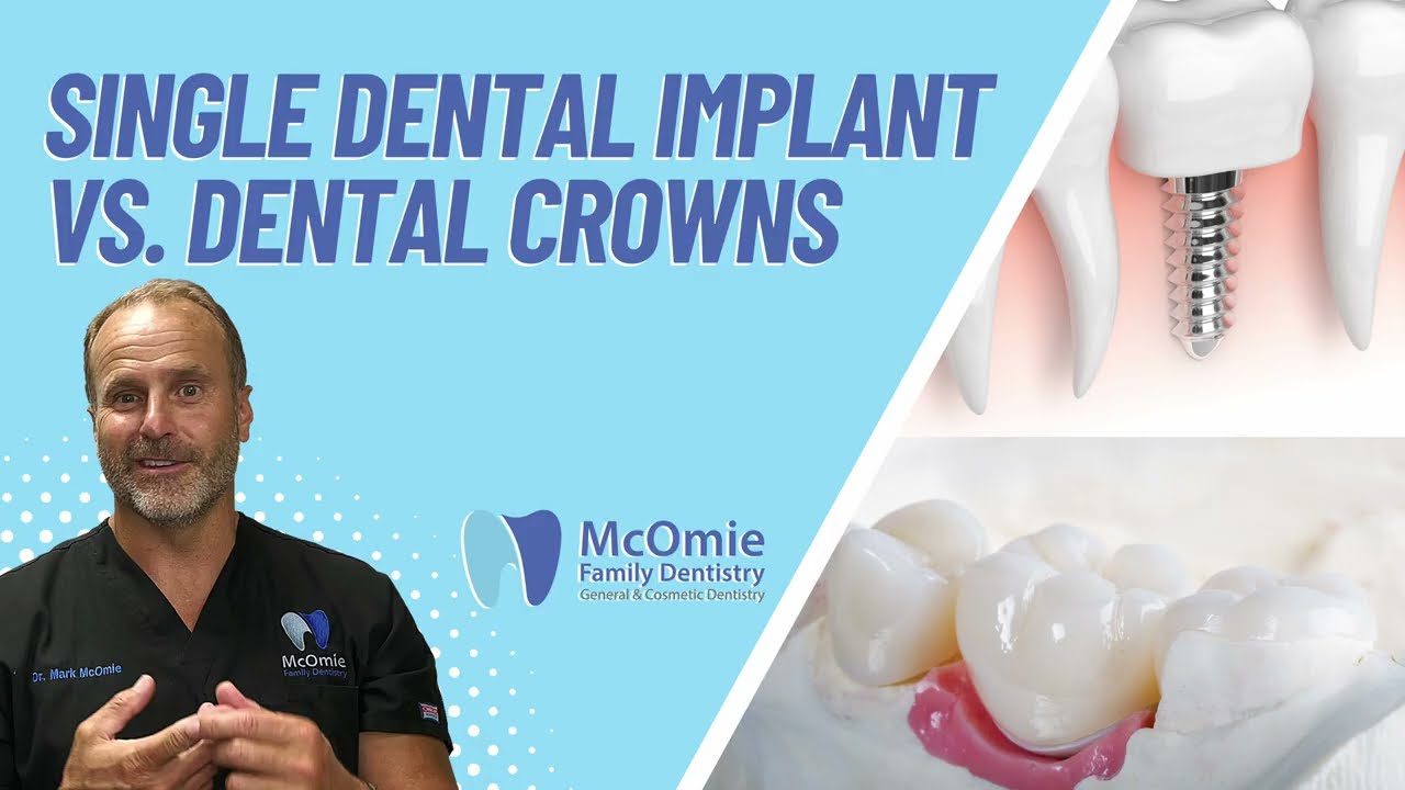 Single Tooth Implant Cost Without Insurance