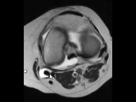 Tratamentul articular Bosphilio