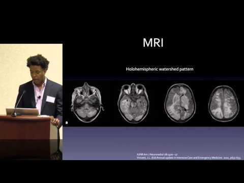 Posterior Reversible Encephalopathy Syndrome (PRES): Who, What When? by Tommy T. Thomas, MD, PhD