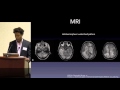 Posterior Reversible Encephalopathy Syndrome PRES Who What When By Tommy T Thomas MD PhD