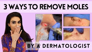 3 Ways to Remove Moles by a Dermatologist