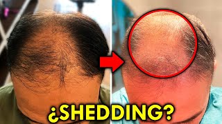 Shedding Alarmante ¿Dejo O Sigo El Tratamiento