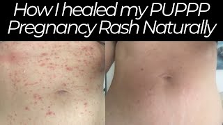 How I Healed my PUPPP Pregnancy Rash Naturally